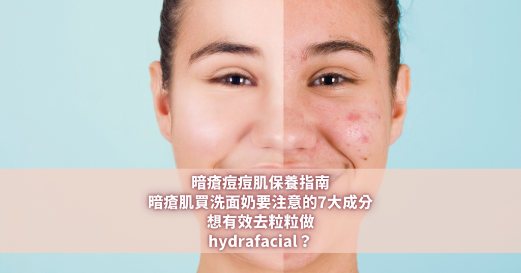 暗瘡痘痘肌 hydrafacial